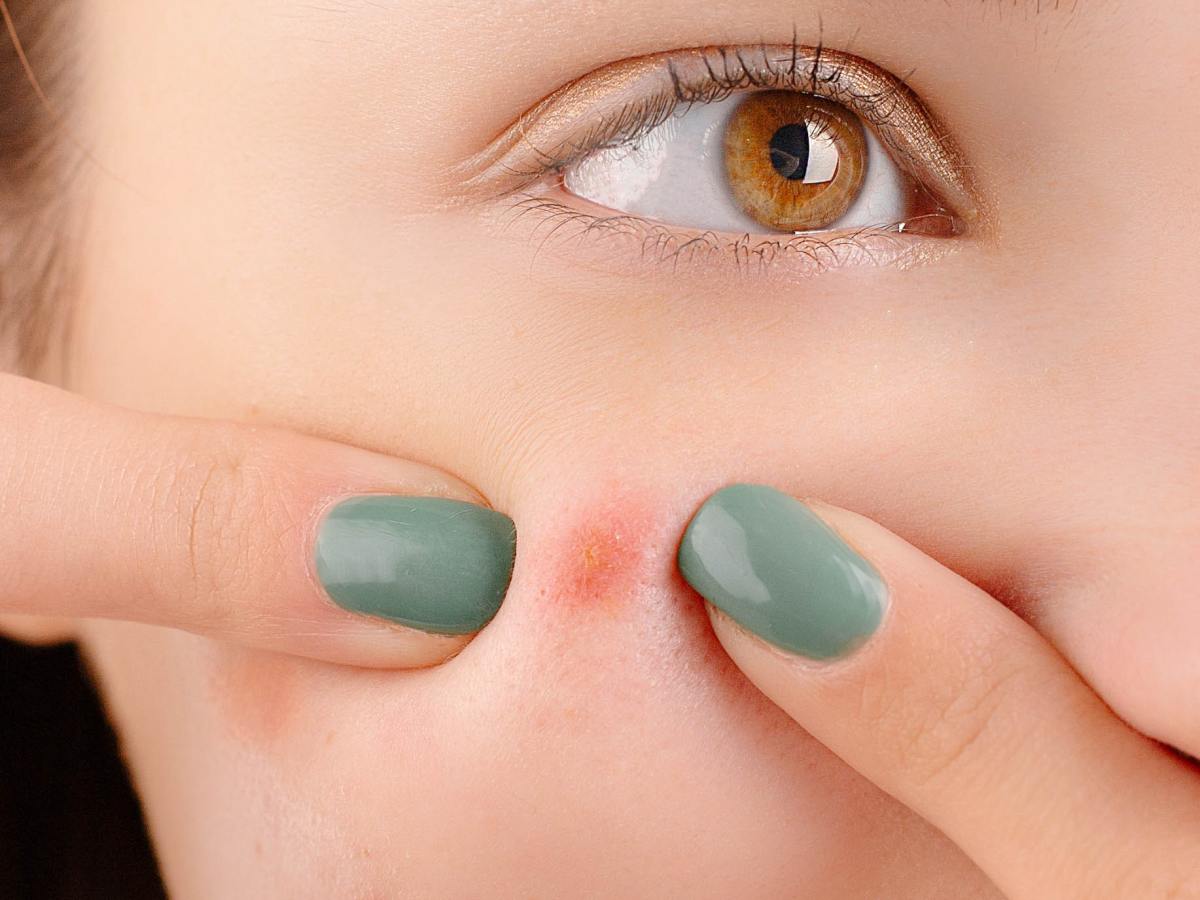 5 שיטות טבעיות לטיפול באקנה שיכולות להציל את העור&nbsp;שלך